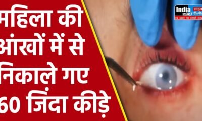 China News: महिला की आंखों से 60 से अधिक जिंदा कीड़े निकाले! डॉक्टर हैरान