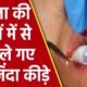 China News: महिला की आंखों से 60 से अधिक जिंदा कीड़े निकाले! डॉक्टर हैरान